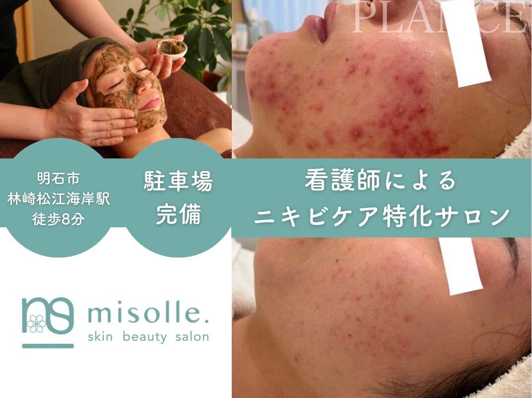 ハーブピーリングで肌質改善を実現するミソルのサービス紹介