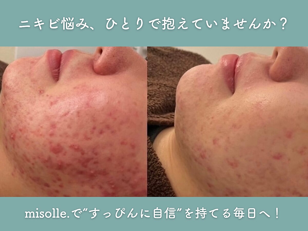 施術シーン：ハーブピーリング × 看護師ケアで肩・首まわりを丁寧にケア