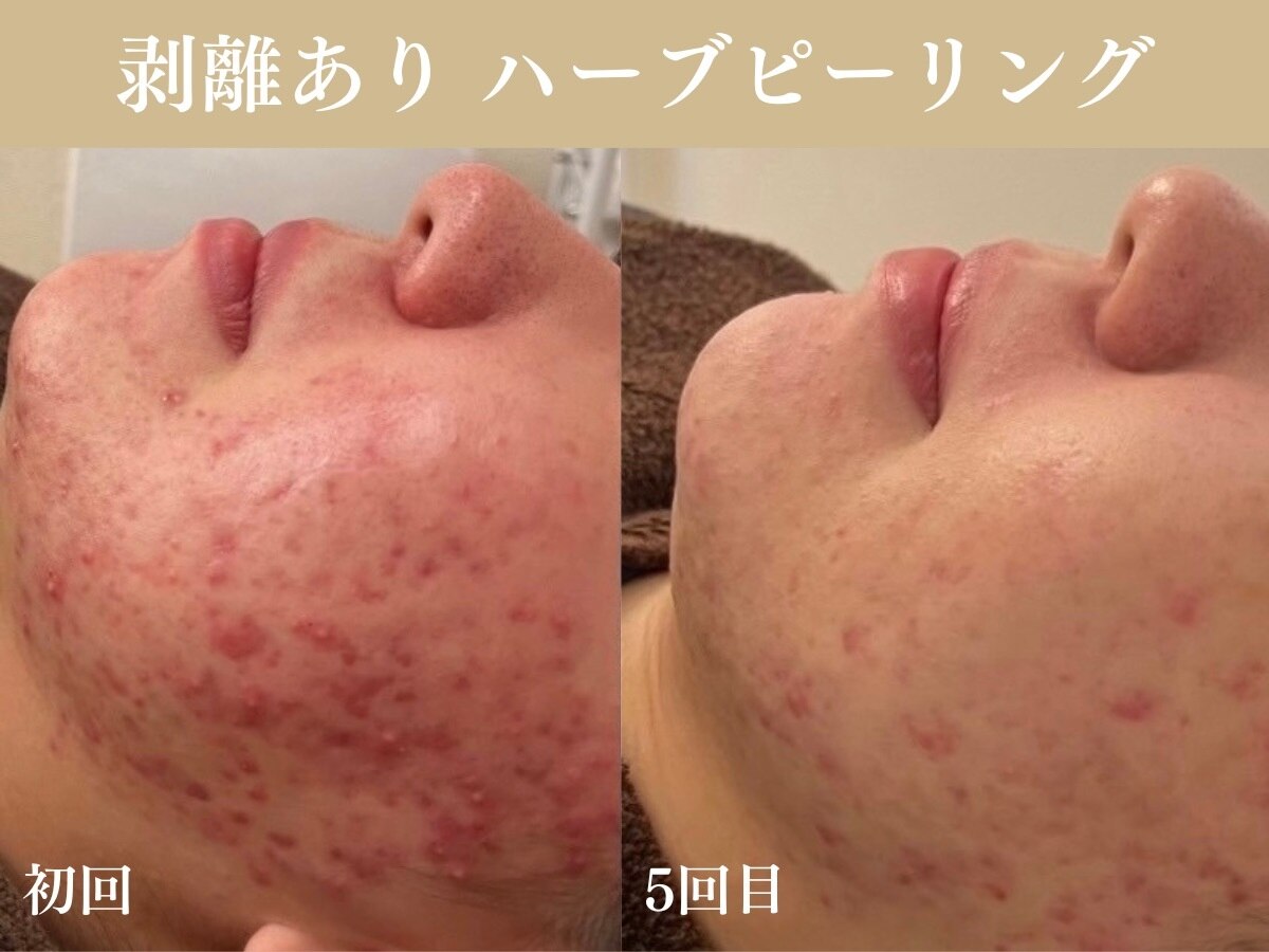 After Tea：施術後のなつめ茶・サンザドリンクでリラックス